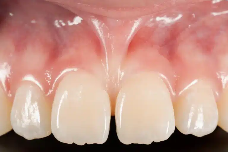 How to Evaluate a Smile Makeover Case Before Choosing a Dentist Near You