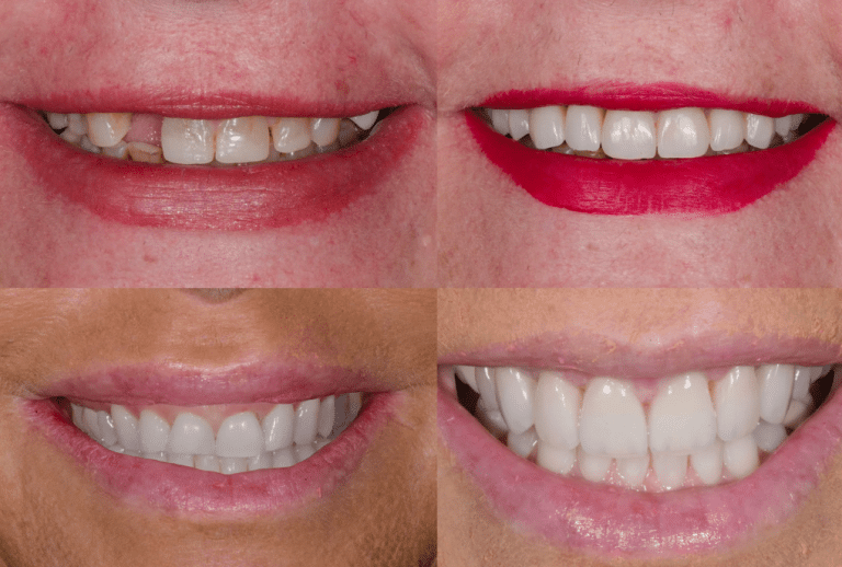 Veneers Cost Explained: What Really Drives the Price (and How to Plan with Confidence)