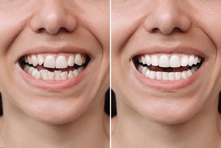 Dental Bonding Before and After: Real Cases to Guide Your Smile Decision