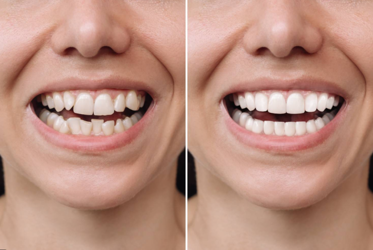 How Long Do Veneers Last? Lifespan, Care Tips, and When to Replace